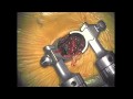 Minimally Invasive Lumbar Fusion (short version)