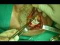 implant dental video preview 02