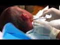Matts cyst getting delt with
