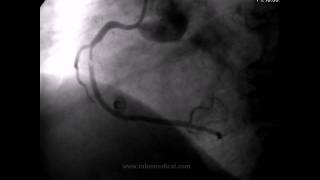 Cateterismo Cardiaco.