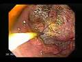 Endoscopia de Cáncer Gástrico Avanzado