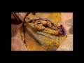 Quill SRS Laparotomy Midline