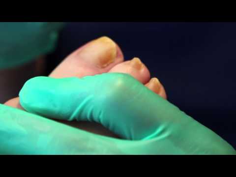 how to cure psoriasis on feet