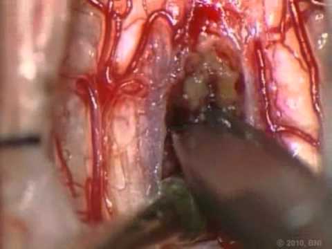 Spinal Cord Intramedullary Cavernous Malformations- Surgical Approaches - Video 1