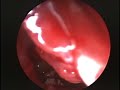 Anterior Wall Sphenoid Sinusotomy Anterior Wall Sphenoid Sinusotomy