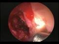 Anterior  Wall Sphenoid Sinusotomy