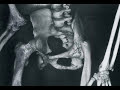 Joseph Merrick......The Elephant Man Joseph Merrick......The Elephant Man
