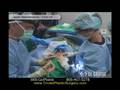Upper Blepharoplasty (Eyes) and Face Lift, Dr. Cruise