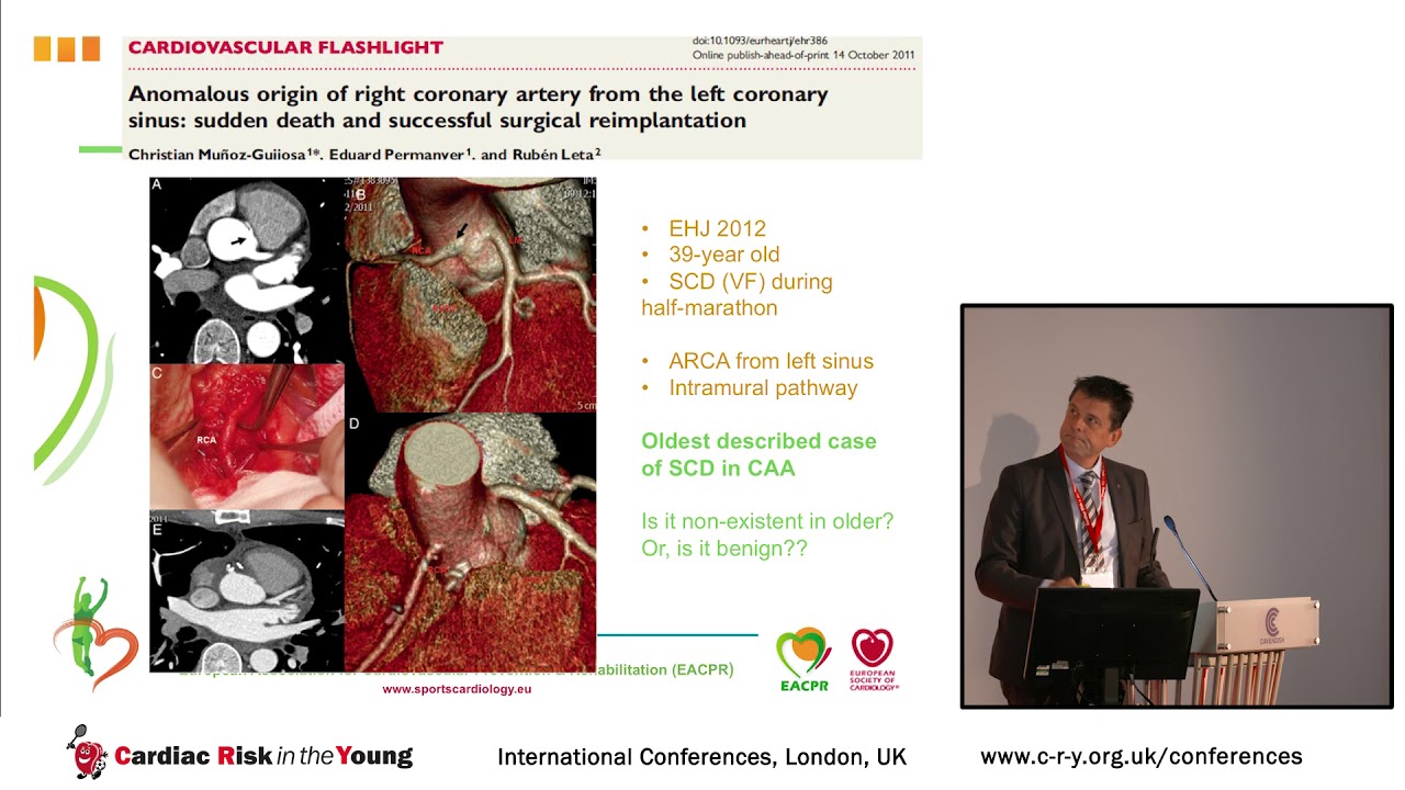 Prevalence of coronary artery anomalies - Prof Mats Börjesson