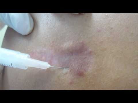 how to treat bcg vaccine scar