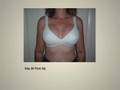 recovery from breast augmentation