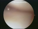 Knee arthroscopy 1