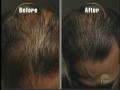 Dateline NBC #3 - Hair Growth Treatments: 6-month Results Dateline NBC #3 - Hair Growth Treatments: 6-month Results