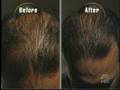 Dateline NBC #3 - Hair Growth Treatments: 6-month Results