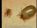 Lyme disease