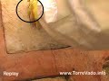 Puntura di unape - puncture of a bee