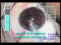 Posterior Polar Cataract Surgery Posterior Polar Cataract Surgery