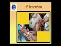 Pediatric IV insertion#