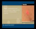Removal of pigments with Q-Switched laser from Asclepion