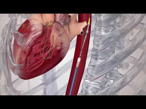 Remplacement de la valve aortique par cathéter (TAVI) - Centre de  Cardiologie Interventionnelle Belledonne