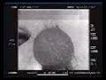 Explosión globo de agua