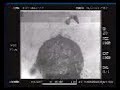 Explosión globo de agua