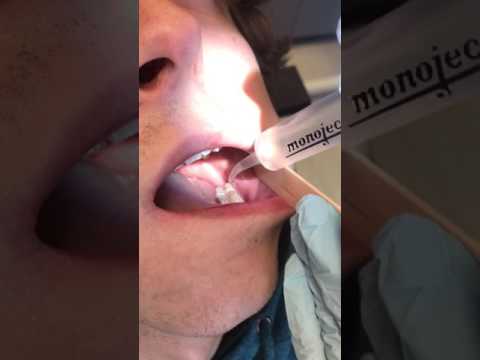 video-linktoworks-Irrigating Sockets After Wisdom Tooth Removal - Oral...