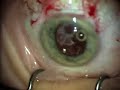 Intraocular Lens Implant