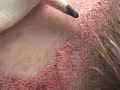 Hair transplant dallas:  creating the female hairline