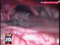 MyFox Los Angeles Doctors Find Worm in Woman's Brain from pork