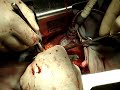 MINIINVASIVE CARDIAC SURGERY