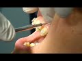 Microimplantes en Ortodoncia Alta definicion Rosario Argentina Lombardi Maximiliano Ortodoncista