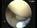 Medial Meniscectomy