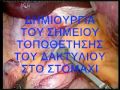 laparoscopic gastric banding
