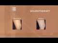 PWTV - Sclerotherapy Leg Vein Treatment Sclerotherapy