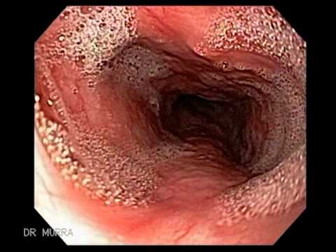 Retoscopia rígida - Airway stents, similar to vascular stents, are devices designed to keep tubular structures open and stable. Airway stents are intended for placement in the c...