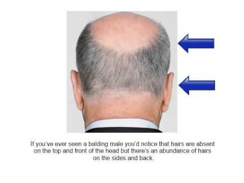 how to sleep after fue hair transplant