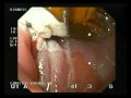 Barrett's Esophagus - Halo 90 Endoscopic Therapy Barrett's Esophagus - Halo 90 Endoscopic Therapy