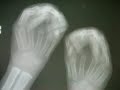 2006 POF-AOFAS Orthopedic Surgical Project 2006 POF-AOFAS Orthopedic Surgical Project