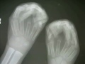 2006 POF-AOFAS Orthopedic Surgical Project
