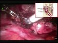 9266GYN Fertility-sparing Robotic Assisted Trachelectomy & Bilateral Pelvic Lymphadenectomy in...