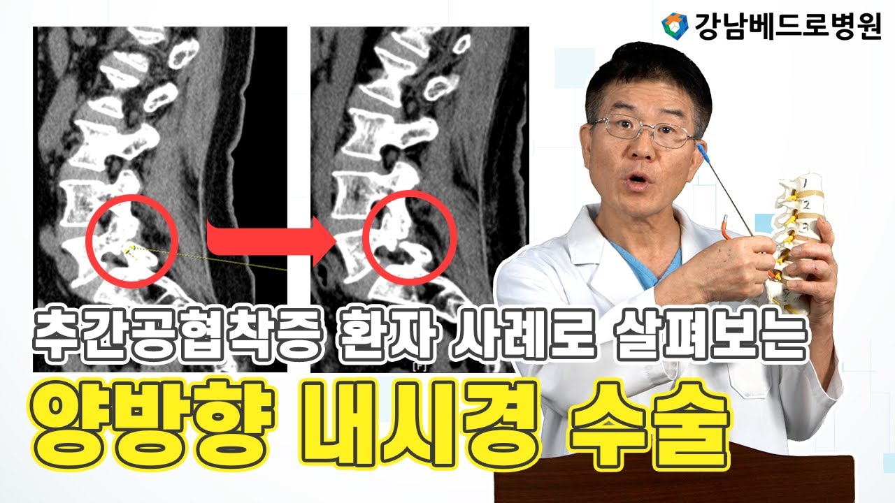 추간공협착증 환자 사례로 살펴보는 양방향 내시경 수술?