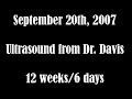 aaron davis baby ultrasound