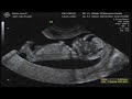 aaron davis baby ultrasound