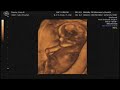 aaron davis baby ultrasound