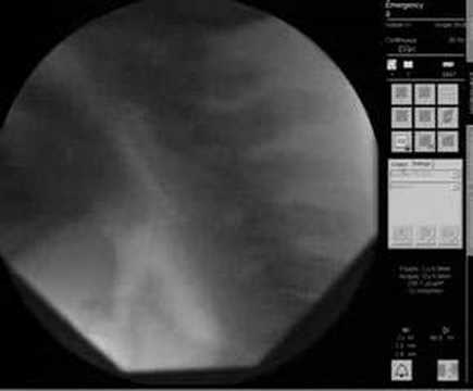 Sword swallowing X Ray - Dai Andrews