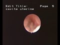 Hysteroscopic aspect of endometrial cancer  Cancer Endometrial Cancer