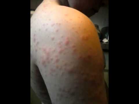 how to treat amoxicillin rash