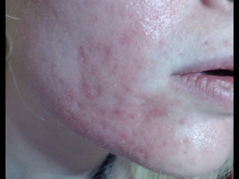 how to use a dermaroller for acne scars