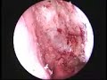 OTORHINO SURGERY